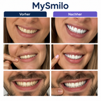 MySmilo V34 Whitening Strips – mit der Doppel-Weiß Formel