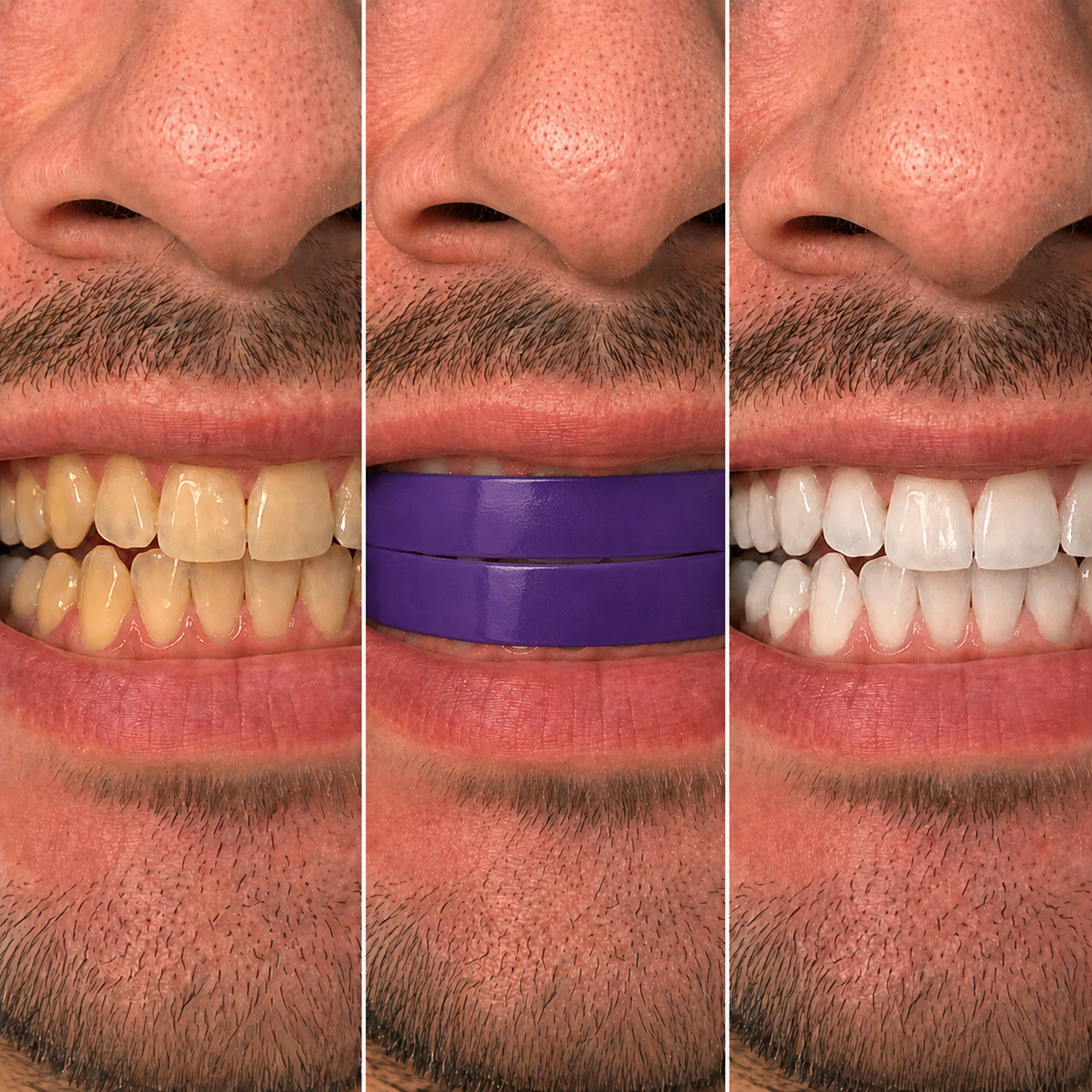 MySmilo V34 Whitening Strips – mit der Doppel-Weiß Formel